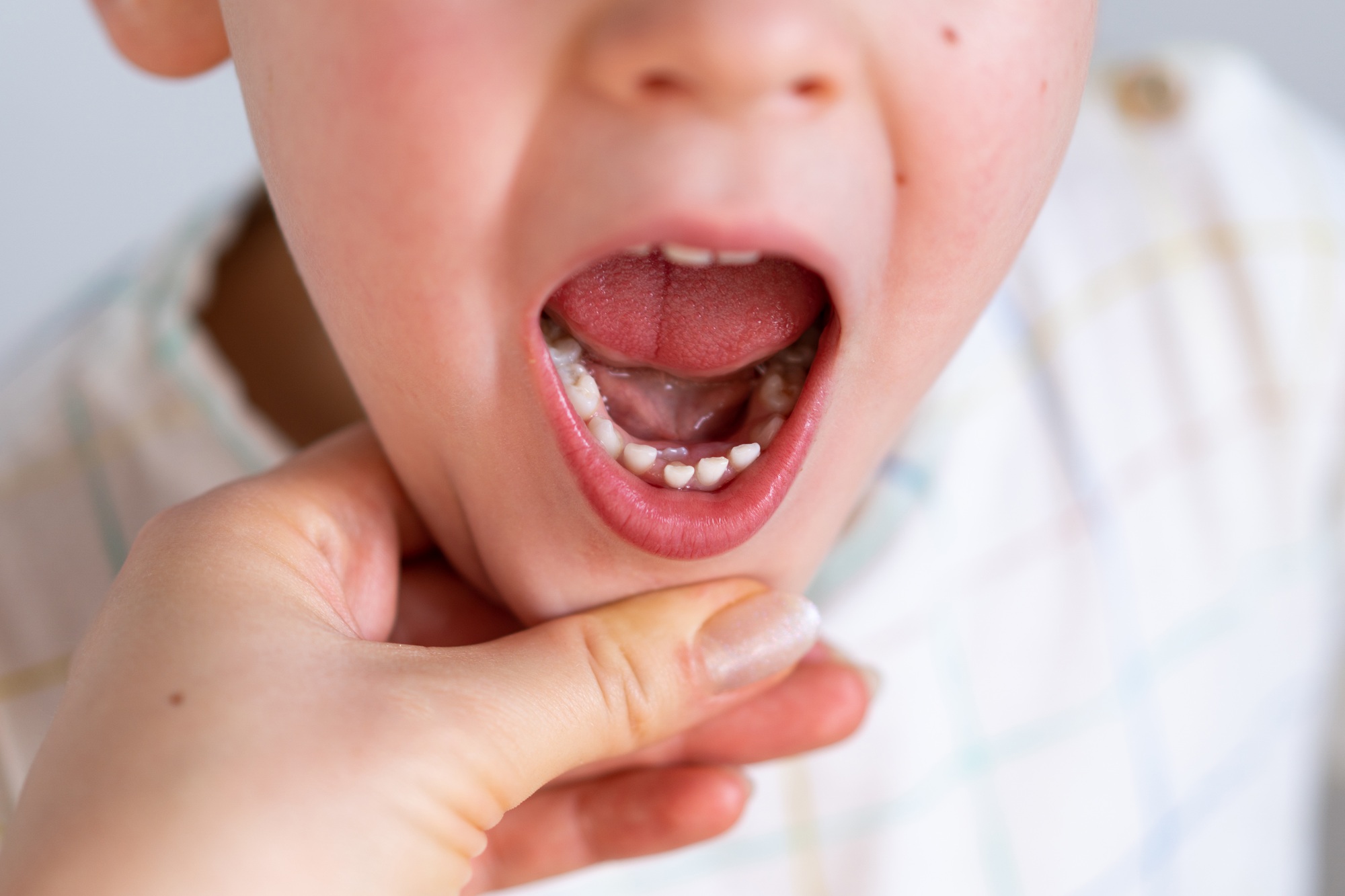 Children shark teeth, first tooth that appears in childhood behind baby teeth.